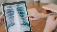 Pulmonologists reviewing a chest X‑ray to evaluate lung health during cancer treatment.